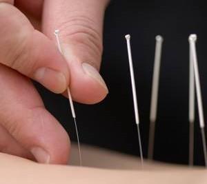 Acupuncture and infertility - Image showing needles being inserted